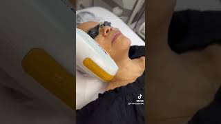 IPL Photofacial treatment for Pigmentation Removal [upl. by Elliven547]