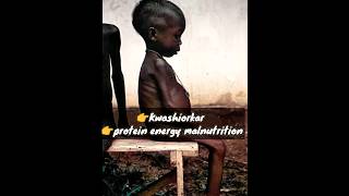 Kwashiorkor Severe Deficiency of Protein mbbs next [upl. by Ardet]