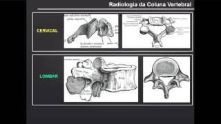 Radiologia da Coluna Vertebral [upl. by Lauzon257]