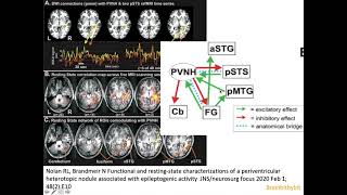 7 Heterotopia epilepsy PVNH malformation cortical development filamin CDK5 MRI neuroradiology [upl. by Nehtanoj906]