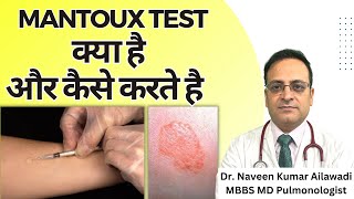 Mantoux Test क्या है और कैसे करते है  Mantoux tuberculin skin test TST TB Test  Diagnosis of TB [upl. by Atikin499]