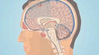 Understanding Subarachnoid Hemorrhage [upl. by Cosimo]