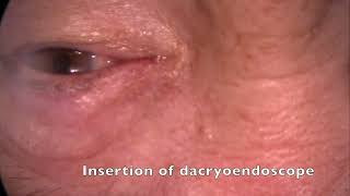 Lacrimal duct parameters based on dacryocystography  Supplementary video ID 370800 [upl. by Sunshine257]