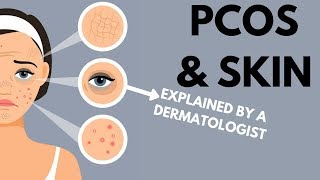 PCOS amp Skin  Dermatologist Review [upl. by Zakaria254]