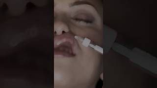 Lip Filler  Russian Lip Technique [upl. by Hgielrac687]