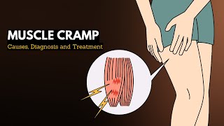 Muscle cramp Causes Signs and Symptoms Diagnosis and Treatment [upl. by Darbie]