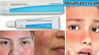 Advantan Cream Review  How to Treat Facial Rash at Home Benefits  How to Use Advantan Cream [upl. by Proctor214]