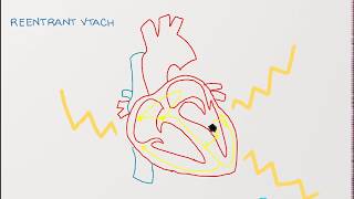 Ventricular Tachycardia  Types Causes and Treatment Approaches [upl. by Areem451]