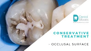 Conservative treatment occlusal surface [upl. by Adnarim604]