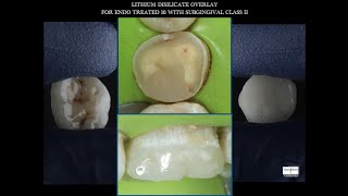 LITHIUM DISILICATE OVERLAY FOR ENDO TREATED MOLAR WITH SUBGINGIVAL CARIES [upl. by Gilles]