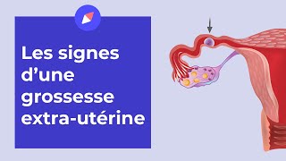 Grossesse extrautérine  les signes à connaître [upl. by Helse]