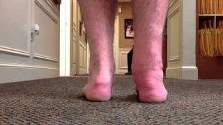 Gait after Arthroscopic Ankle Fusion SFISM [upl. by Aicatsanna55]