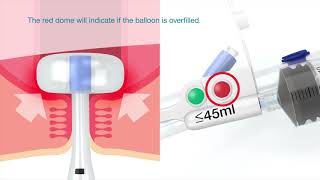 Flexi Seal™ PROTECT FMS Fill Protection [upl. by Yngiram]