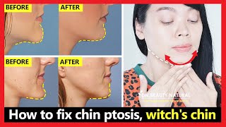 How to fix chin ptosis witchs chin chin correction chin long get beautiful chin without surgery [upl. by Ruthe]