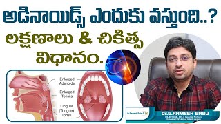 అడినాయిడ్స్ ఎందుకు వస్తుంది  Adenoids or Adenoid Hypertrophy Treatment  Dr Ramesh Babu ENT [upl. by Durno872]