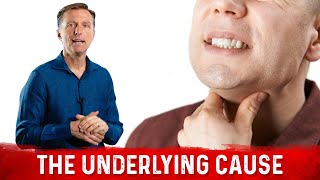 Burning Throat Syndrome or Silent Acid Reflux Causes – DrBerg [upl. by Nahij90]