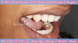 উঁচু দাঁতের ব্রেসেস চিকিৎসা শেষ হয়েছে। Braces treatment of protruded front teeth Dr Md Anwar BDS [upl. by Mahseh]