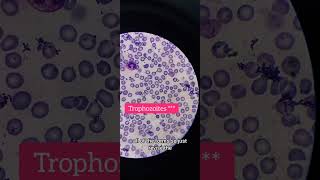 MP slide Plasmodium vivax on oil immersion 100× laboratory hematology [upl. by Anyzratak]