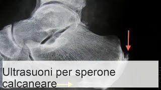 Recensioni sullefficacia della terapia ad onde durto per speroni calcaneali [upl. by Oivlis]