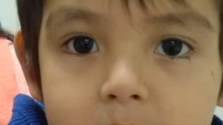 Nystagmus Video Pelizaeus Merzbacher [upl. by Esalb]