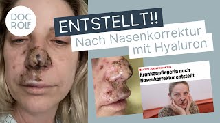 NASENKORREKTUR OHNE OP – Wienerin entstellt 😱 – Dr Rolf Bartsch [upl. by Evars52]