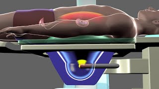 How extracorporeal shockwave lithotripsy is used to treat kidney stones  Bupa Health [upl. by Siraval454]