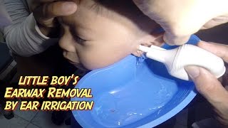 Little Boys Earwax Removal by Ear Irrigation [upl. by Madson]