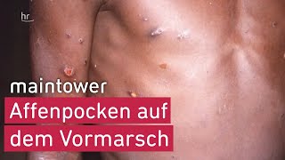 Kommen die Affenpocken nach Hessen  maintower [upl. by Oliva]