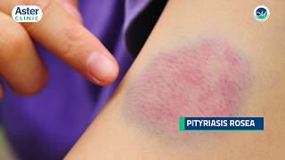 Dr Srinivasa Munivenkatappa talks about Pityriasis Rosea [upl. by Ynnel]