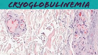 Cryoglobulinemia type 1 pathology USMLE dermpath dermatology [upl. by Ahtibat]