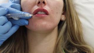 Juvederm lip filler injection by Dr Shaun Patel in Miami Florida [upl. by Lottie]