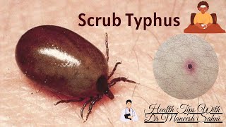 Scrub Typhus Early diagnosis and treatment [upl. by Allayne]