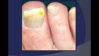 Toenail Debridement by a Podiatrist [upl. by Purcell]