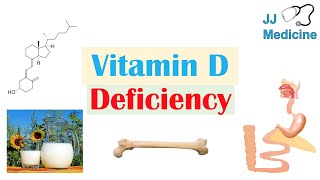 Vitamin D Deficiency  Absorption amp Metabolism Purpose of Vit D Causes of Deficiency [upl. by Apple691]