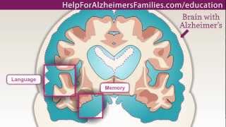 Alzheimers Effect on the Brain [upl. by Nolahp388]