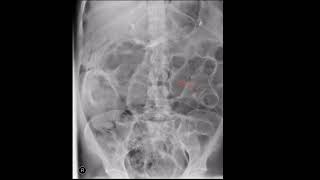 Rigler’s sign  Pneumoperitoneum [upl. by Ennoira]