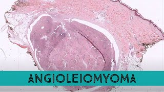 Angioleiomyoma leiomyoma vascular type painful skin bump often on leg [upl. by Birdt428]