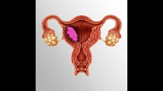 Endometrial Cancer Staging amp Survival rates MRCOG part 2 Simplified [upl. by Dnomayd]