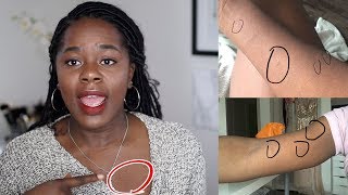 My Skin Story  How I got rid of Pityriasis Rosea  TheAdeTomi [upl. by Pebrook308]