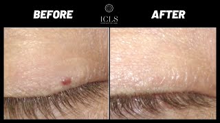 Angioma Treatment Options  Before and After Photos  ICLS Dermatology amp Plastic Surgery [upl. by Noloc222]