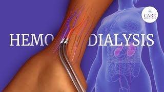 What is Hemodialysis  How is Hemodialysis Done [upl. by Walter131]