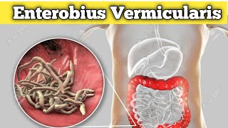 Enterobius vermicularis Habitat life cycle and pathogenicity etc [upl. by Adham944]