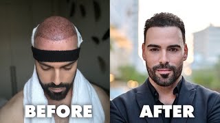 Hair Transplant Results SevenMonth Update  Before and After  Istanbul Turkey with Hairneva [upl. by Drew858]