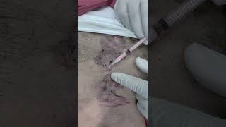 Best Keloid Treatment in Jaipur SkinaaClinic viral shorts [upl. by Beaulieu]