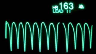 Ventricular Tachycardia [upl. by Orferd587]