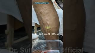 varicose vein Treatment venipuncture varicoseveinstreatment varicosevein drsulfikarali [upl. by Sineray]