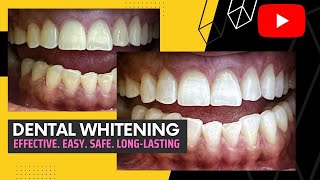 DentalWhitening Effective Easy Safe Longlasting [upl. by Eussoj115]