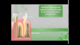 GuttaFlow2 D Root Canal Filling System [upl. by Erodroeht]