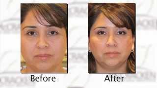 Reducing bags under the eyes with Restylane Injection  Dr Michael McCracken [upl. by Dasya]