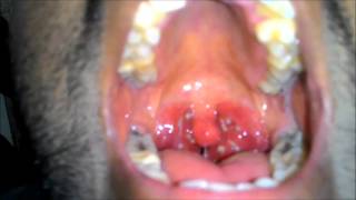 Acute Tonsillitis with Tonsillar exudates [upl. by Oecam405]